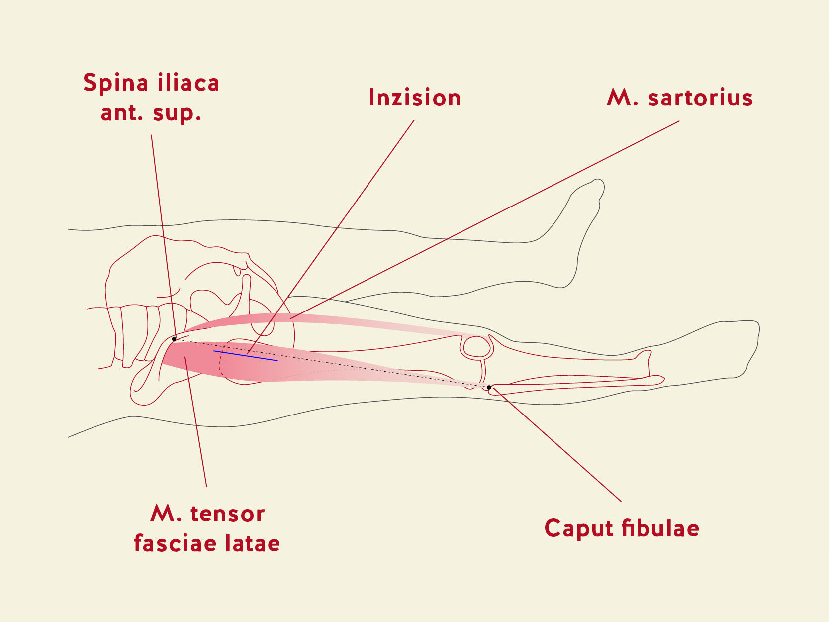 Schematische Darstellung des Hautschnittes (Inzision) beim minimal-invasiven, vorderen Zugang.