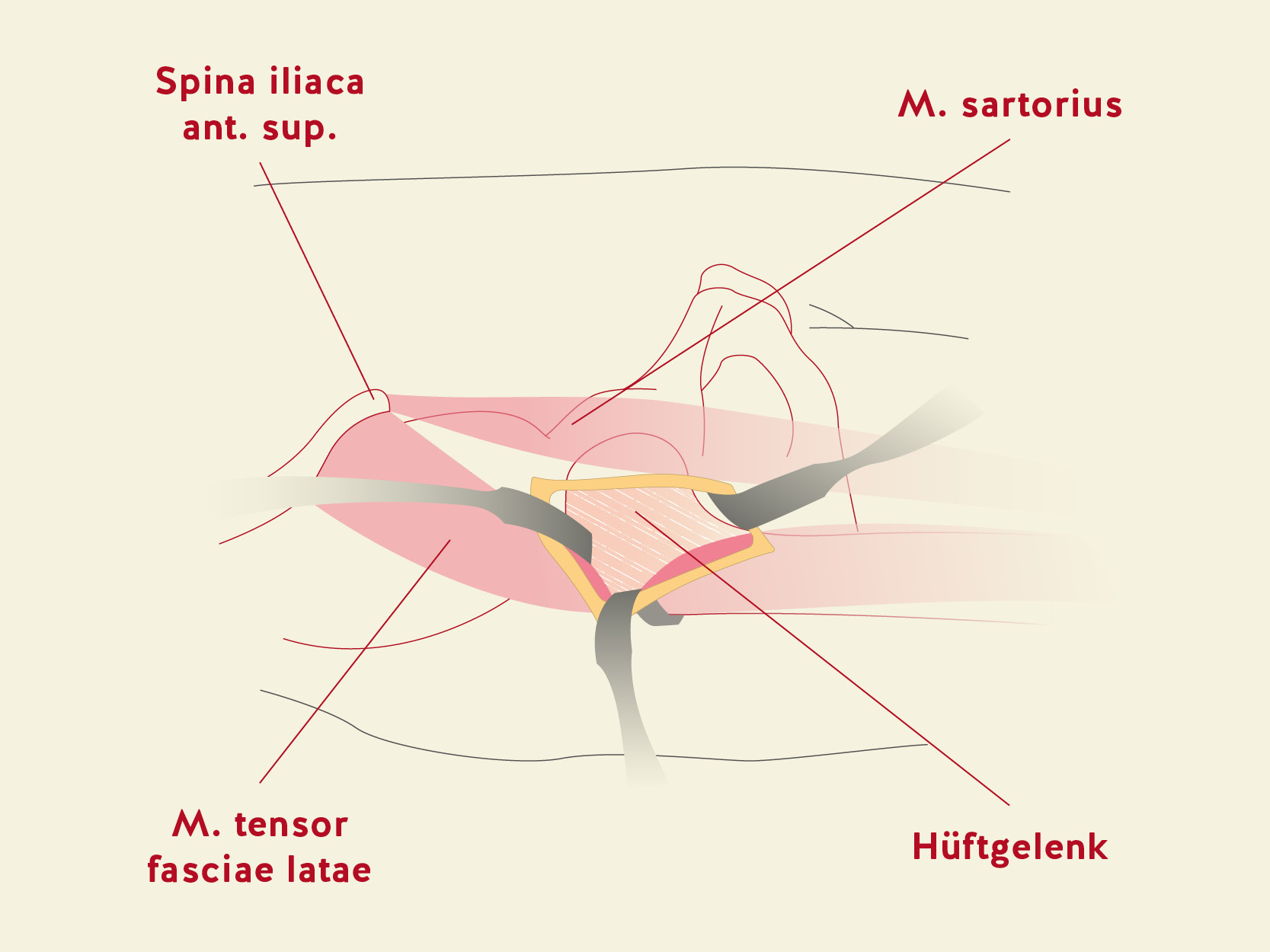 Schematische Darstellung des operativen Zugangsweges durch eine Muskelloge beim minimal-invasiven, vorderen Zugang.