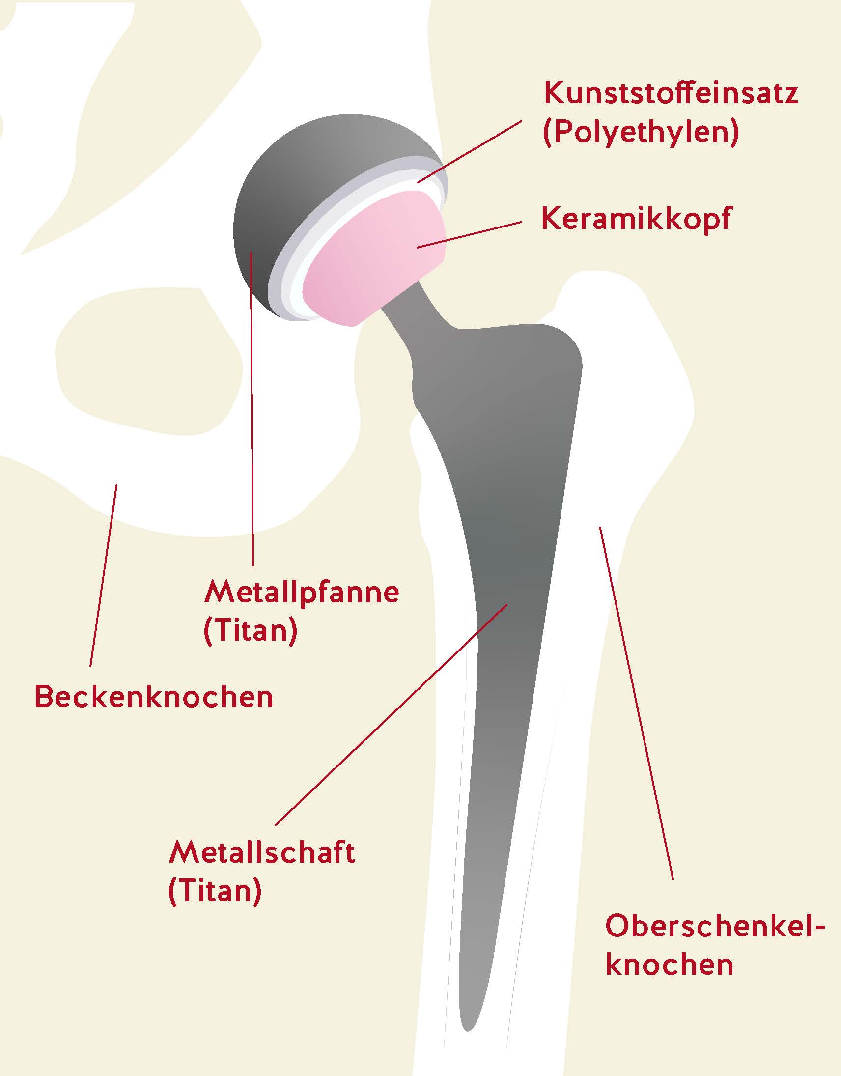 Hftprothese Ausfhrlich  OCW Wrzburg